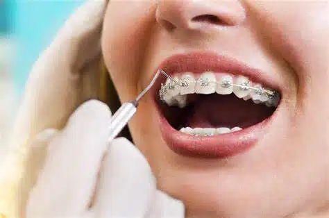 Metal Braces vs Clear Braces
