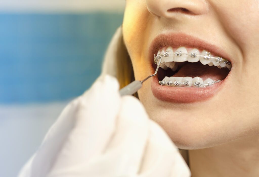 Braces 101