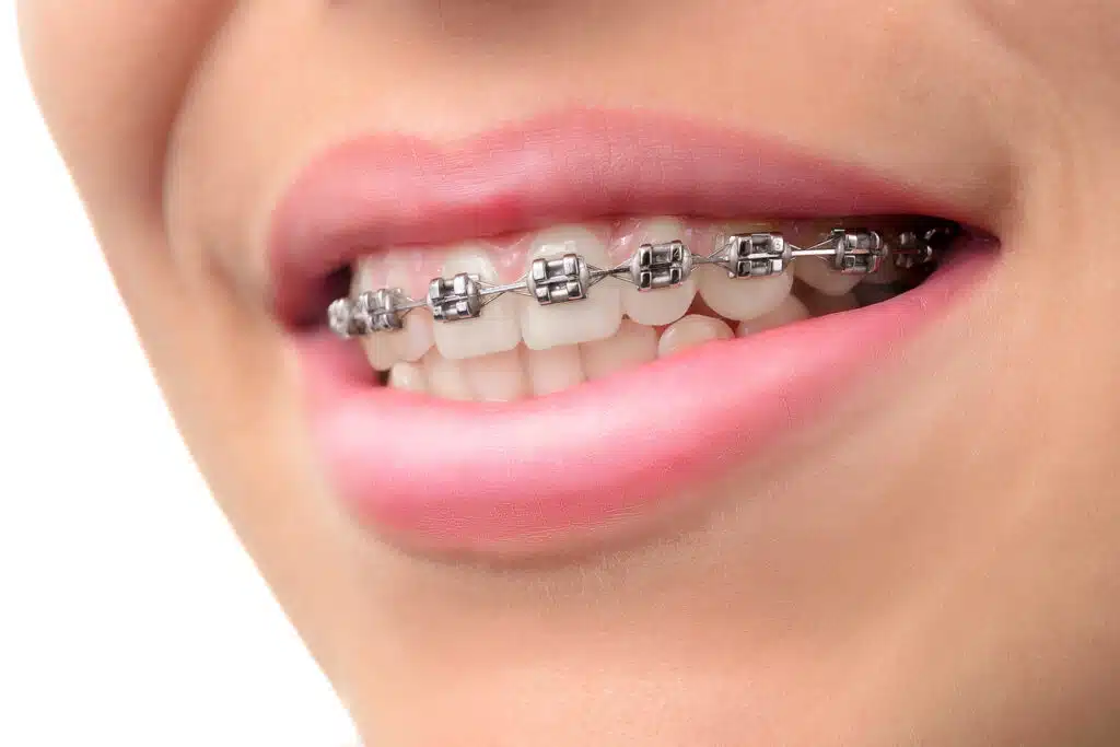 Caring for your dental braces