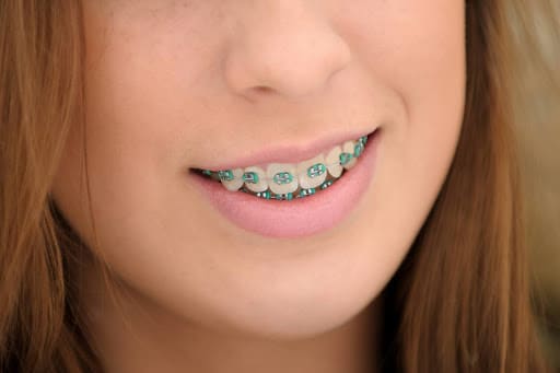 Common problems with traditional braces