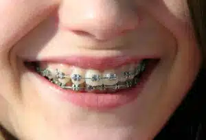 What are the issues with traditional braces