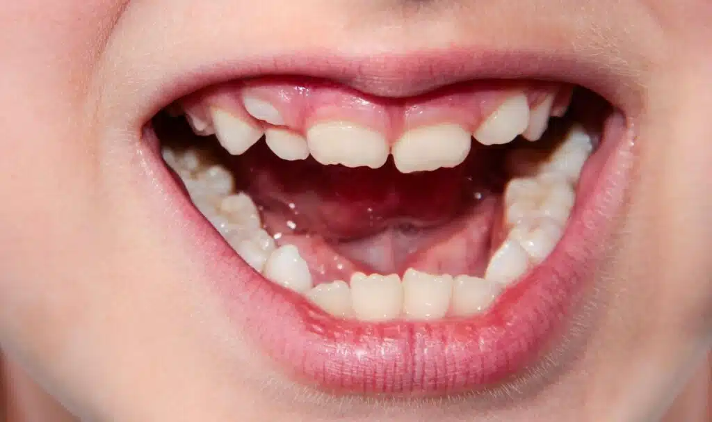 child’s teeth growing out of position