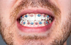 Teen smiling with traditional braces near Phoenix, AZ