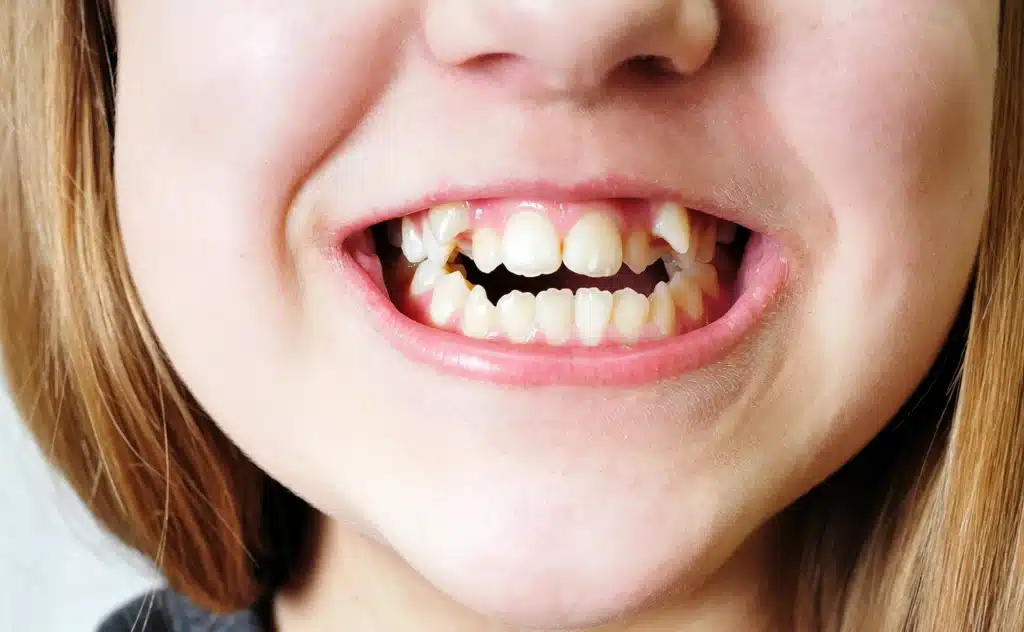 Patient smiling with crowded teeth before orthodontic treatment