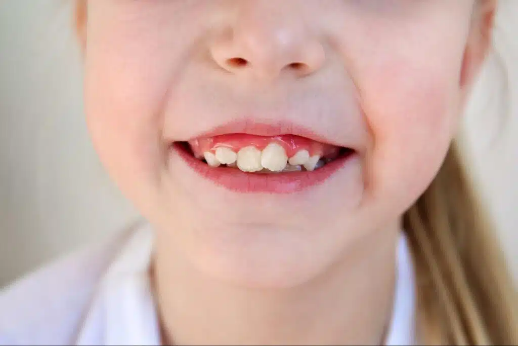 Child with visible crowding and early alignment concerns