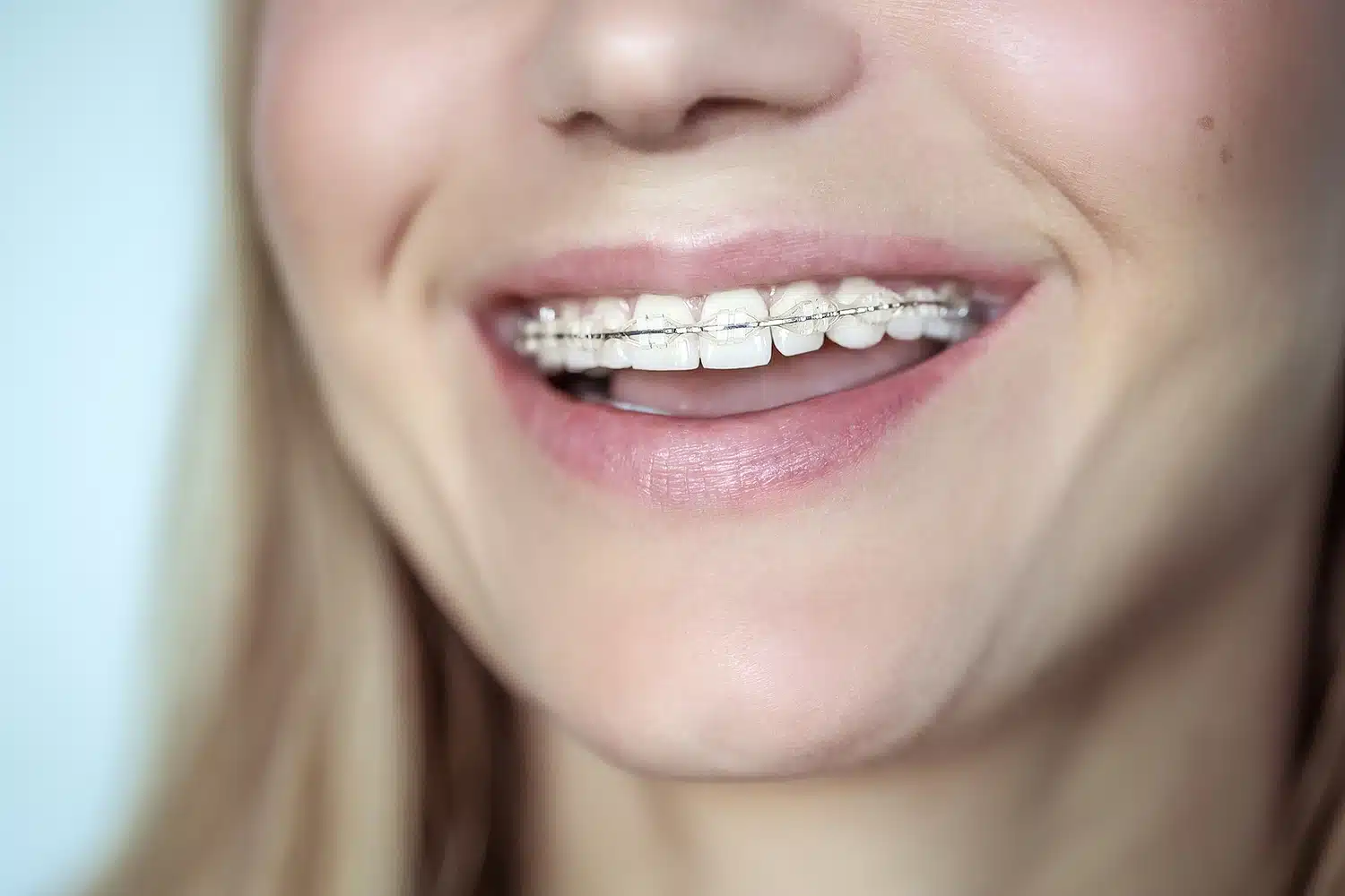 Teen smiling with braces used to correct crooked teeth