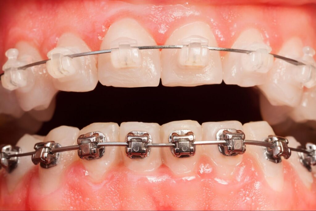 clear braces vs metal braces at Elite Orthodontics