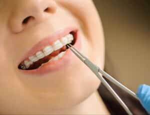 teen patient smiling with clear ceramic braces
