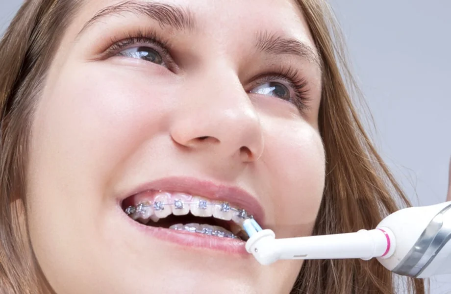 Braces 101