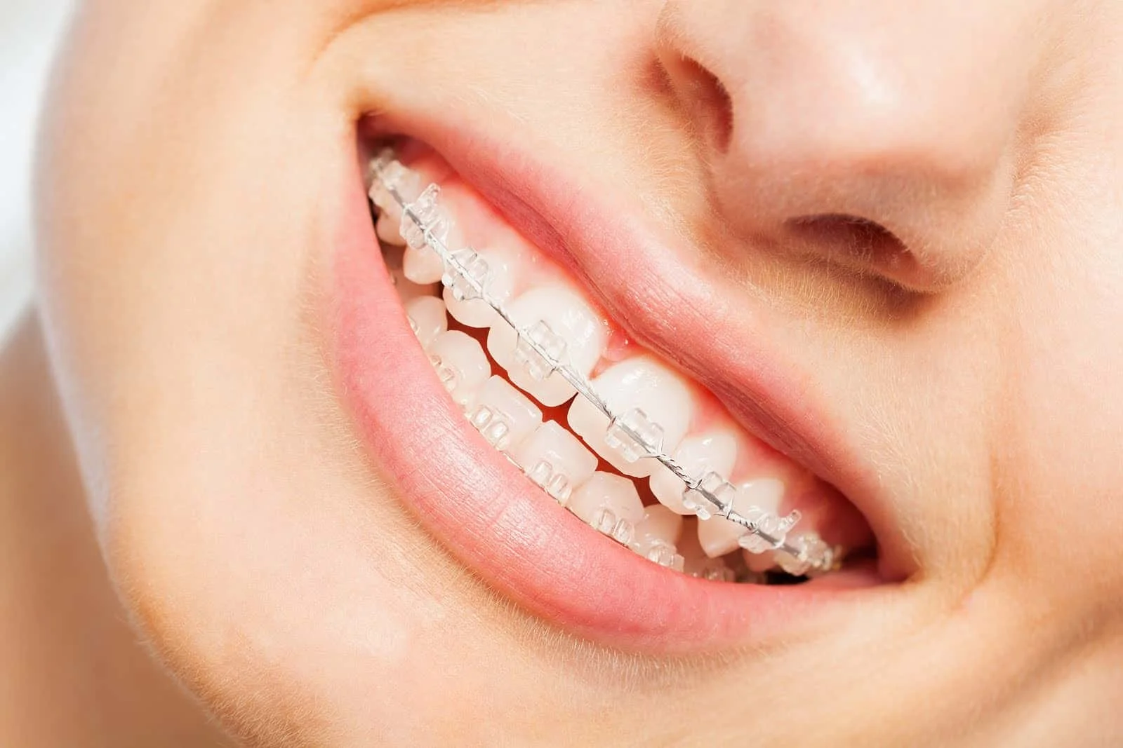 Why clear braces are a smart choice